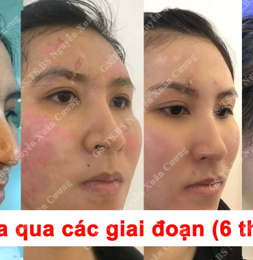 Ca trị sẹo rỗ bằng phương pháp cà da mặt tại Thẩm mỹ Bác sĩ Cương