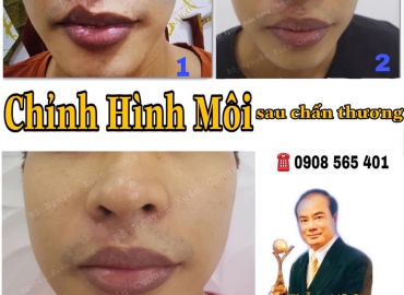 CHỈNH HÌNH MÔI DO CHẤN THƯƠNG